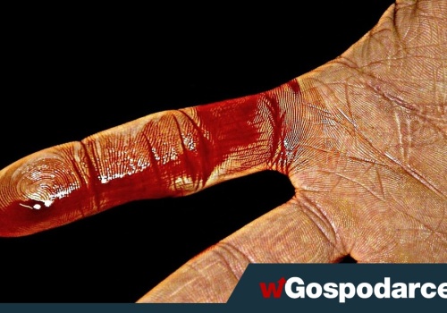 Skaleczenie? Zobacz w jaki sposób goją się rany