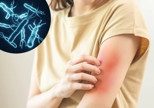 Helicobacter pylori – objawy skórne zakażenia. Z czym można je pomylić?