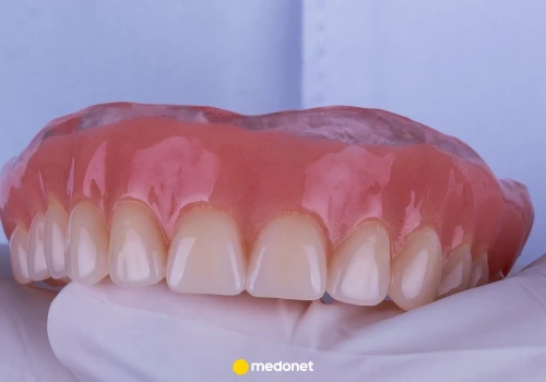 Proteza zaczyna wypadać i psuje uśmiech. Dentystka radzi, co można zrobić 