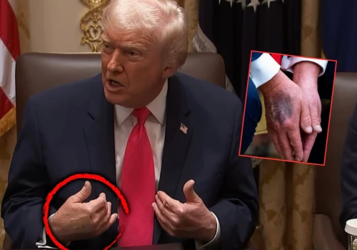 A jednak! Trump przejdzie badania, powraca temat tajemniczych siniaków. „Jestem znacznie młodszy niż senior”