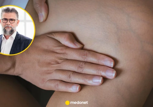 Jak poznać, że ma się wysoki cholesterol? Kardiolog: to trochę jak z nowotworem