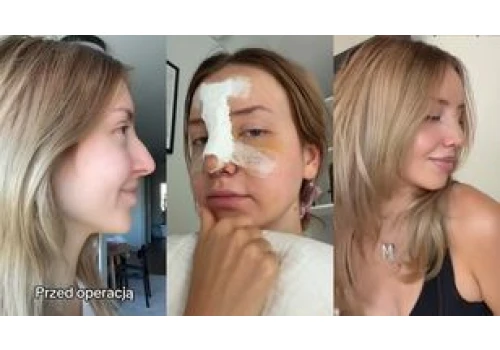 Monika Kociołek zafundowała sobie NOWY NOS. Pokazała efekty PRZED I PO. Zmiana na plus? (ZDJĘCIA)
