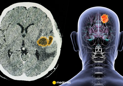 Neurochirurg: glejak wciąż jest jednym z najtrudniejszych nowotworów do leczenia