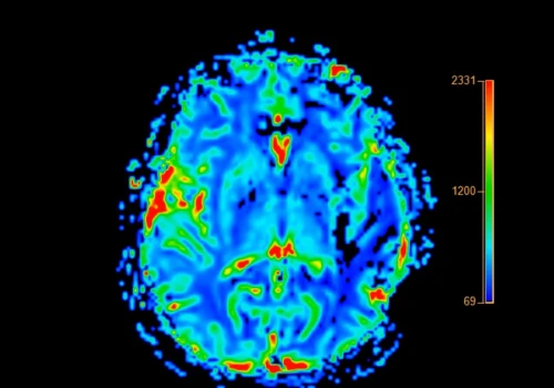 Jak zatrzymać rozprzestrzenianie się Alzheimera? Nowe odkrycie daje nadzieję