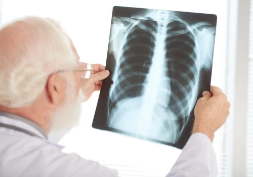 Eksperci: wprowadzenie badań przesiewowych to największy postęp w diagnostyce raka płuca od wielu lat