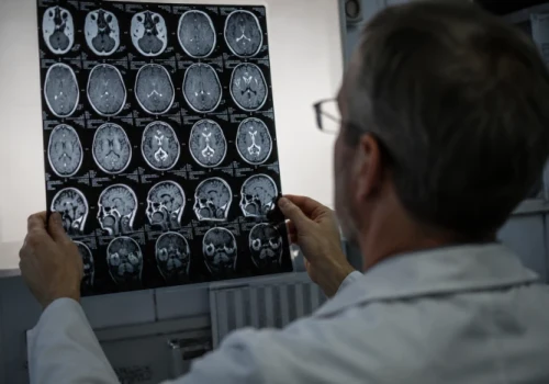 Pierwsza taka immunoterapia u ludzi wydłużyła przeżycie bez progresji glejaka ponad dwukrotnie