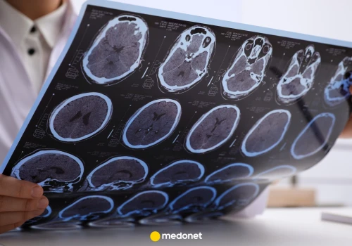 Nowe badanie zmienia podejście do SM. Ta terapia dorównuje droższym lekom