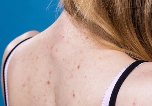 Wypryski na plecach latem do zmora. Dermatolog radzi, jak się ich pozbyć
