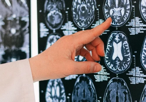 Światowy Dzień Mózgu. „Choroby neurologiczne dotyczą nawet 1 na 3 osoby”. Badanie u ponad 1000 seniorów daje nadzieję