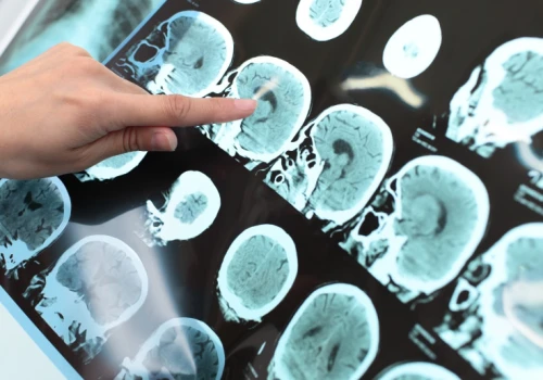 Eksperymentalna immunoterapia daje nadzieję dzieciom z agresywnymi guzami mózgu