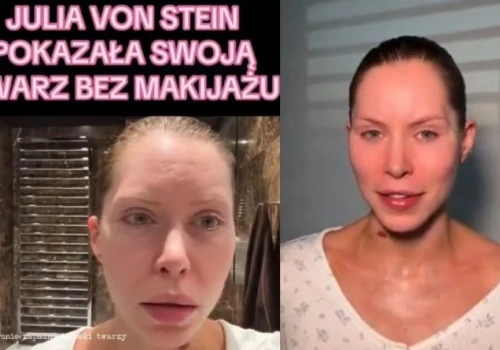 Julia von Stein ostrzega przed operacjami plastycznymi. Twierdzi, że teraz nie może się uśmiechać i musi przejść kolejną operację