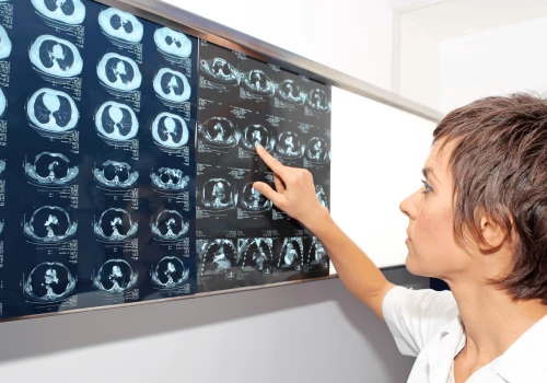 Rak płuca: darmowa tomografia od 1 października. Zobacz zasady programu
