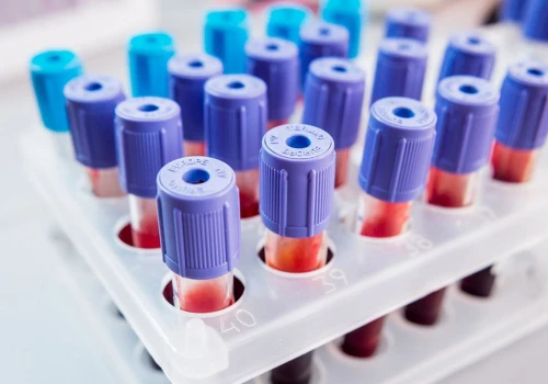 Konflikt serologiczny w ciąży - objawy, przyczyny, badania i profilaktyka