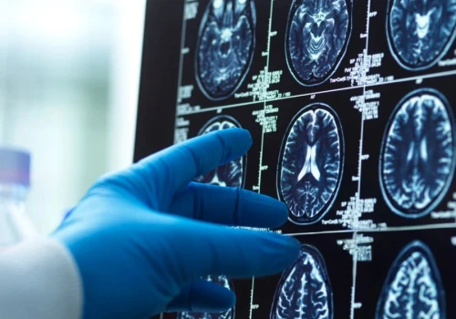 Co powoduje rozwój choroby Alzheimera? 