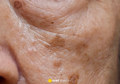 Przebarwienia po opalaniu? Ten krem ściera je jak peeling kwasowy u kosmetyczki