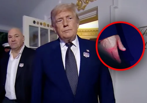 Lekarz byłego prezydenta zobaczył siniaki Trumpa. Jaśniej się nie da! „Zbyt długo trzymano nas w niewiedzy”