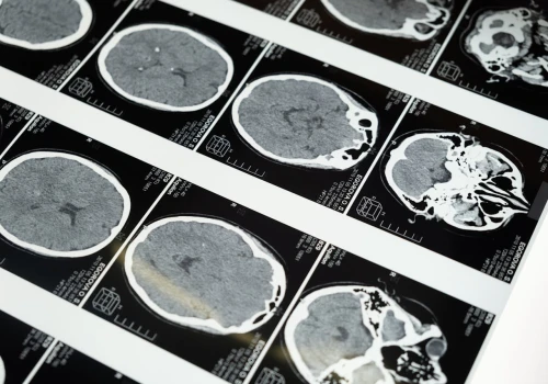 Nowa technologia mapuje glejaka w 3D. Analiza trwa około 30 minut
