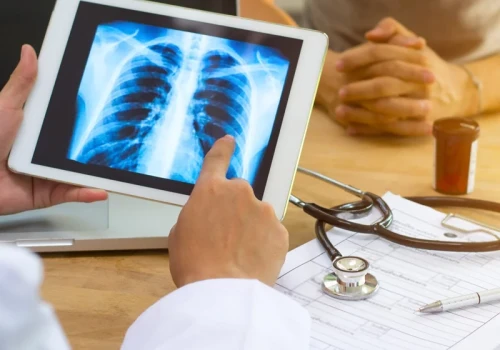 Rak płuca zabija najczęściej. Oto nietypowe objawy, które mogą opóźnić diagnozę i leczenie