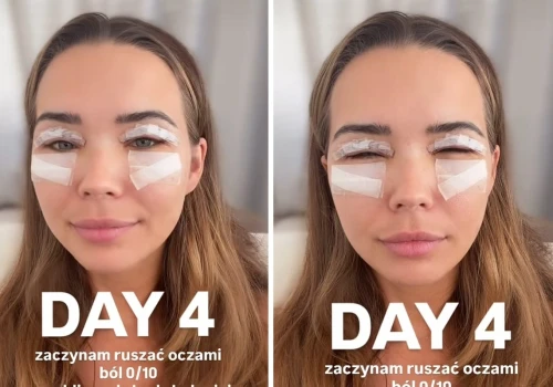 Sandra Kubicka pokazała, jak wygląda po operacji powiek. 