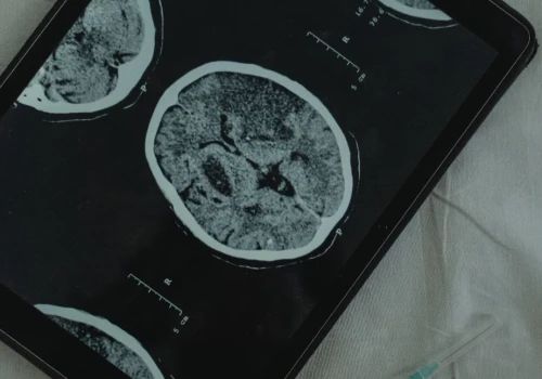 Naukowcy zbadali mózgi osób z depresją. Odkryli zaburzenia neurogenezy