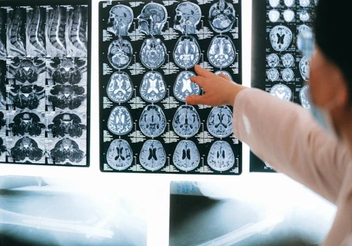 AI wspierała neurochirurga podczas operacji mózgu. Pierwszy taki zabieg na świecie