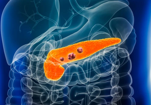 FDA zatwierdza daraxonrasib. Nowa terapia dla pacjentów z rakiem trzustki