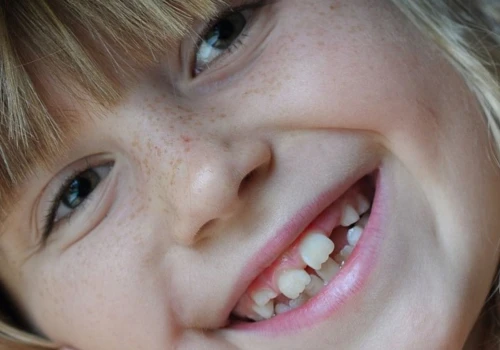 Białe plamy na zębach dziecka. Skąd się biorą i kiedy warto zgłosić się do dentysty