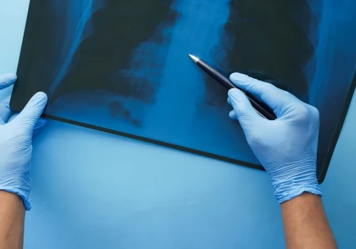 Liczba nowych przypadków raka może wzrosnąć o 67 proc. do 2050 roku