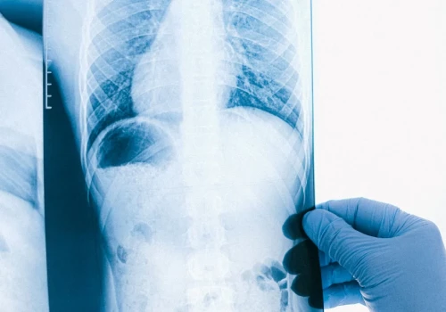 Wziewny lek zmniejszył opór w naczyniach płucnych i poprawił wydolność pacjentów. Nowa terapia pozytywnymi wynikami badania II fazy