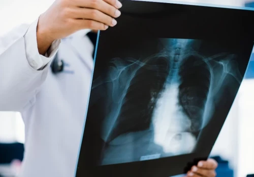„Ludzie nie myślą kategoriami chorób. Zauważają objawy”. Włóknienie płuc: tu liczy się czas