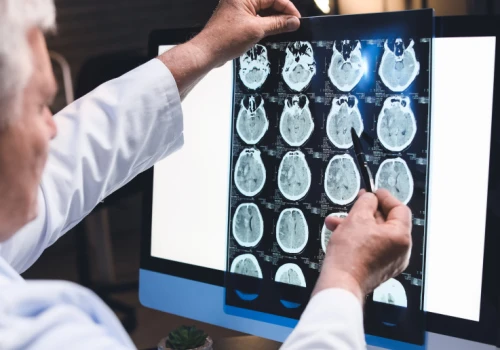 Neurolog: napędza rozwój alzheimera. Robimy to sobie przez lata