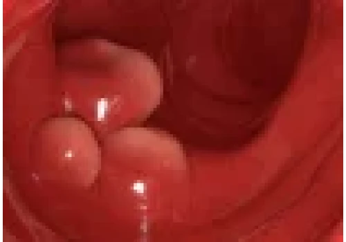 Modyfikowane gen. probiotyki eliminują 43% nowotworów jelita grubego u myszy..