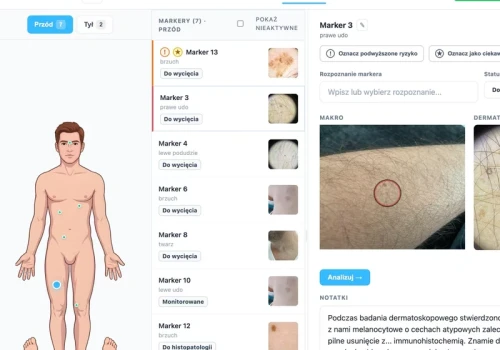 Smartfon pomoże ocenić niepokojącą zmianę na skórze? Polski projekt w światowej czołówce