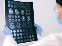 AI wykrywa ukryte migotanie przedsionków u pacjentów po udarze – obiecujące wyniki