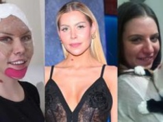 Julia von Stein zafundowała sobie lifting twarzy. Pamiętacie, jak KIEDYŚ wyglądała?