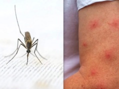 Potrzyj obrzęk skórką owocu. Cudowne antidotum na ukąszenie komara