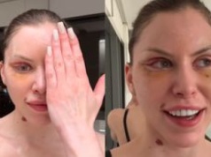 Julia von Stein prezentuje odmienione oblicze 8 DNI PO OPERACJI: 