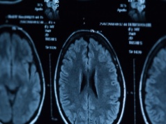 Choroba Parkinsona może mieć początek w nerkach, sugerują naukowcy