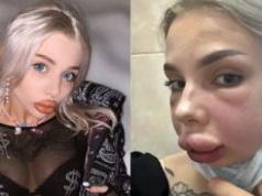 Rosyjska influencerka chciała zmniejszyć usta. Przez błąd kosmetologa SPUCHŁA i otarła się o śmierć