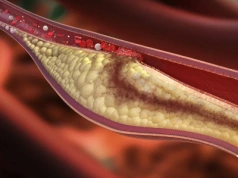 Podwyższony cholesterol nie boli. 5 niebezpiecznych mitów związanych z cholesterolem