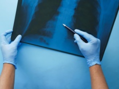 Radioterapia może przełamać oporność na immunoterapię w raku płuca