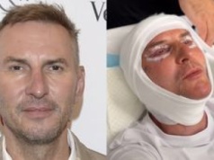 TYLKO NA PUDELKU: Krzysztof Gojdź zafundował sobie lifting za 150 tysięcy złotych! 