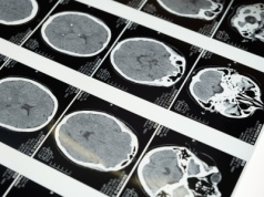 MMI i Jacobs Institute: pionierska mikrochirurgia mózgu z użyciem robota