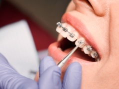 Aparat ortodontyczny na NFZ. Mało kto wie, że można dostać za darmo