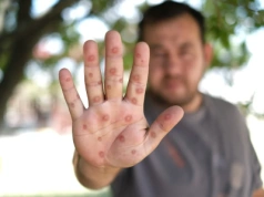 Ospa wietrzna to jedna z najbardziej zaraźliwych chorób. Kto powinien się zaszczepić?