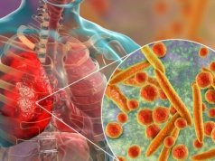 Ta bakteria atakuje coraz częściej. Lekarze biją na alarm. "Reagujemy za późno"