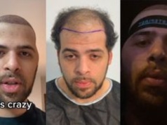 Zrobił przeszczep włosów w Turcji i pojawiły się komplikacje. Pokazał, co stało się z jego twarzą: 