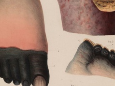 Efekt wojny dronowej: na Ukrainę powróciła choroba okopów I wojny światowej