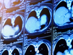 Nowa broń przeciw alkoholowej chorobie wątroby. Rewolucyjne odkrycie naukowców