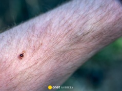 47-latek zmarł wskutek alergii na czerwone mięso. Wywołało ją ukąszenie kleszcza